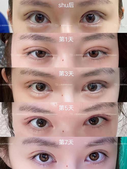 割双眼皮手术会破坏个人的命格吗？