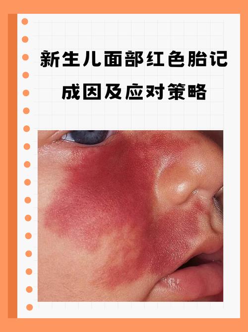 孩子出生有红色胎记是什么命理含义？