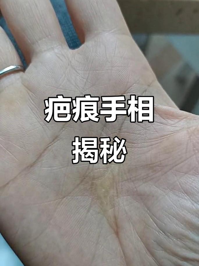 手上有疤的女人命运如何，是何种命格？