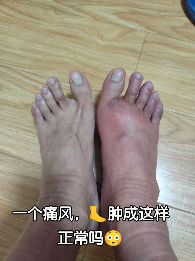 痛风水肿了还嫩洗个澡吗？