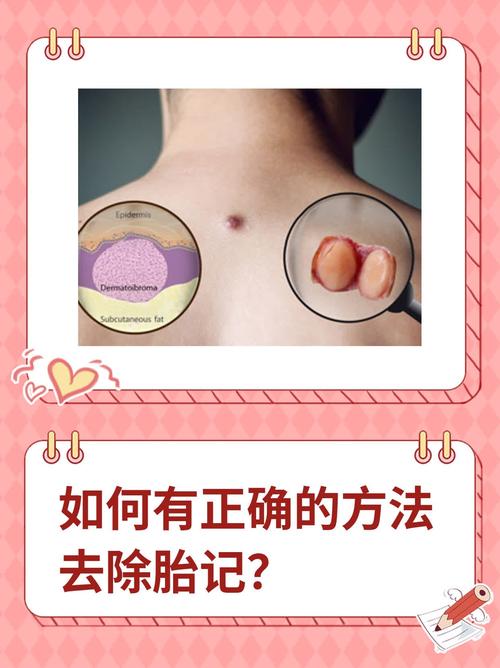 去除胎记对女性风水有影响吗？