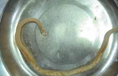 梦见从腿上拔出寄生虫